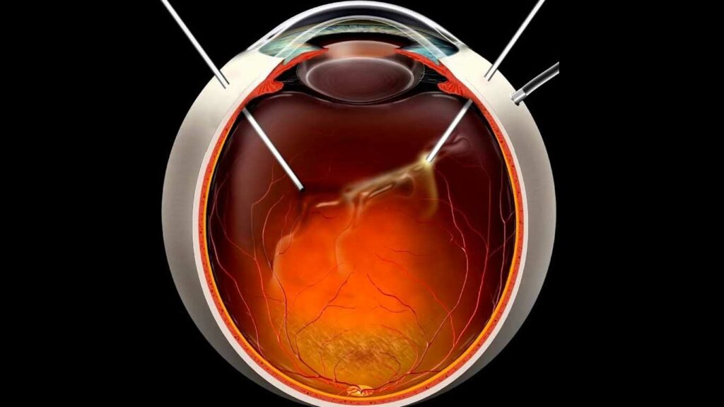 Agujero macular. Enfermedades y tratamientos para los problemas oculares por el Instituto Oftalmológico Recoletas.