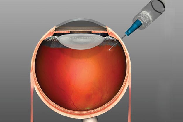 Inyecciones intravítreas. Enfermedades y tratamientos para los problemas oculares por el Instituto Oftalmológico Recoletas. 