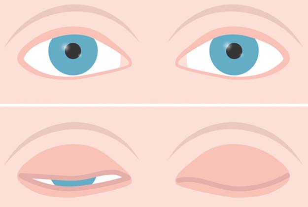 Lagoftalmos. Enfermedades y tratamientos para los problemas oculares por el Instituto Oftalmológico Recoletas.