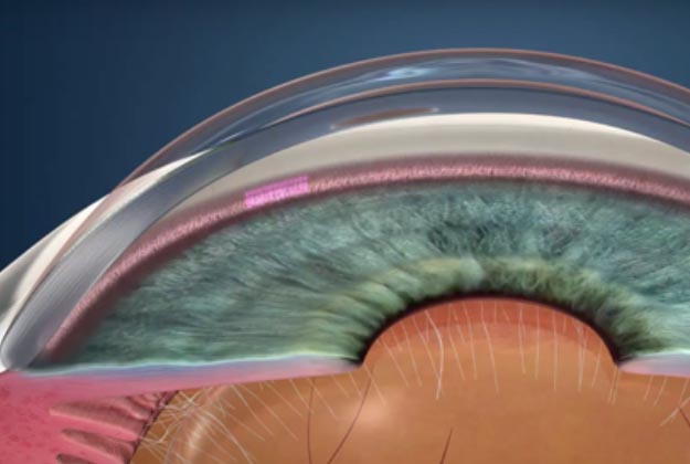 Trabeculoplastia láser selectiva - SLT. Enfermedades y tratamientos para los problemas oculares por el Instituto Oftalmológico Recoletas.