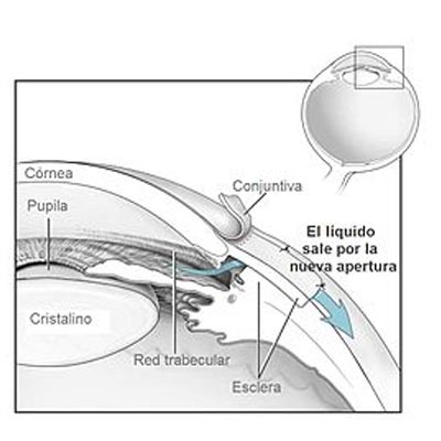 Trabeculectomía. Enfermedades y tratamientos para los problemas oculares por el Instituto Oftalmológico Recoletas.