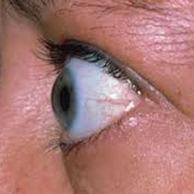 Exoftalmos. Enfermedades y tratamientos para los problemas oculares por el Instituto Oftalmológico Recoletas.