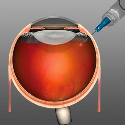 Inyecciones intravítreas. Enfermedades y tratamientos para los problemas oculares por el Instituto Oftalmológico Recoletas. 