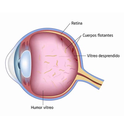 Miodesopsias. Enfermedades y tratamientos para los problemas oculares por el Instituto Oftalmológico Recoletas.