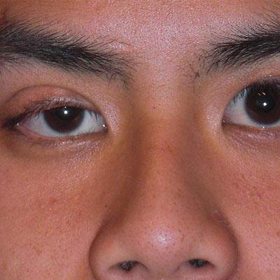 Ptosis palpebral. Enfermedades y tratamientos para los problemas oculares por el Instituto Oftalmológico Recoletas.