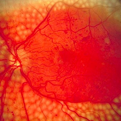 Retinopatía Diabética. Enfermedades y tratamientos para los problemas oculares por el Instituto Oftalmológico Recoletas.