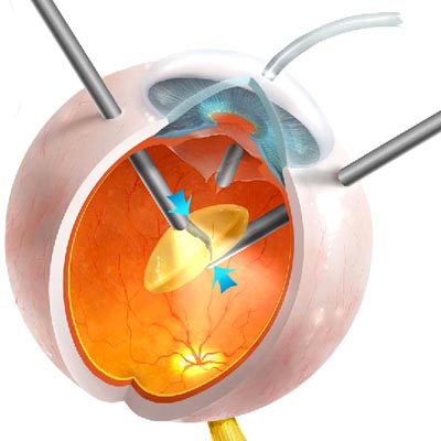 Vitrectomía pars plana. Enfermedades y tratamientos para los problemas oculares por el Instituto Oftalmológico Recoletas.