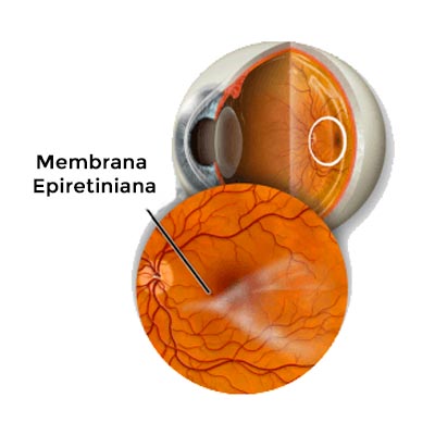Membrana Epirretiniana. Enfermedades y tratamientos para los problemas oculares por el Instituto Oftalmológico Recoletas.