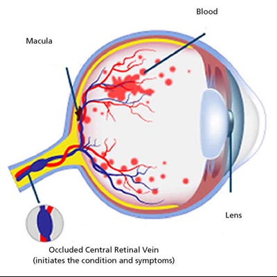 Oclusiones venosas de la retina. Enfermedades y tratamientos para los problemas oculares por el Instituto Oftalmológico Recoletas.