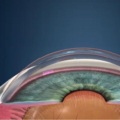 Trabeculoplastia láser selectiva - SLT. Enfermedades y tratamientos para los problemas oculares por el Instituto Oftalmológico Recoletas.
