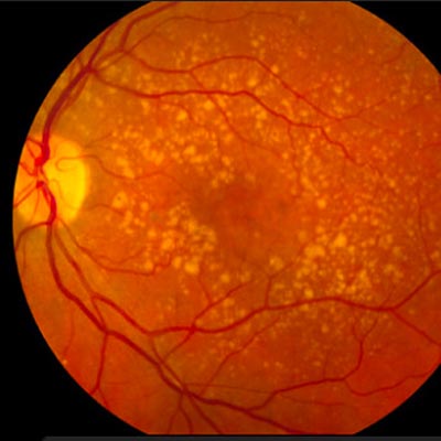 Degeneración Macular Asociada a la Edad. Enfermedades y tratamientos para los problemas oculares por el Instituto Oftalmológico Recoletas.