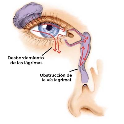 Obstrucción de la vía lagrimal. Enfermedades y tratamientos para los problemas oculares por el Instituto Oftalmológico Recoletas.