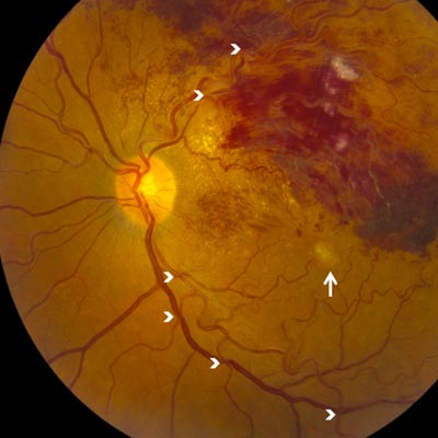 Oclusiones venosas de la retina. Enfermedades y tratamientos para los problemas oculares por el Instituto Oftalmológico Recoletas.