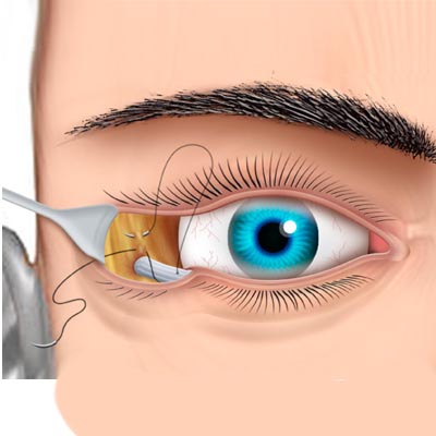 Ectropión. Enfermedades y tratamientos para los problemas oculares por el Instituto Oftalmológico Recoletas.