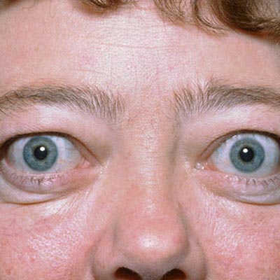 Exoftalmos. Enfermedades y tratamientos para los problemas oculares por el Instituto Oftalmológico Recoletas.