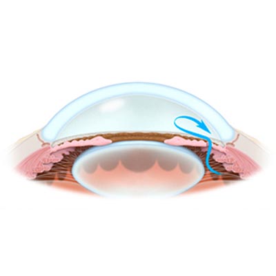 Iridotomia. Enfermedades y tratamientos para los problemas oculares por el Instituto Oftalmológico Recoletas.