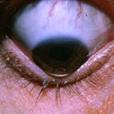 Queratocono. Enfermedades y tratamientos para los problemas oculares por el Instituto Oftalmológico Recoletas. 