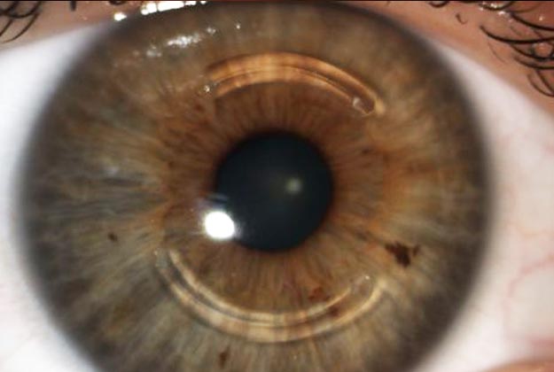Anillos intraestromales. Enfermedades y tratamientos para los problemas oculares por el Instituto Oftalmológico Recoletas.