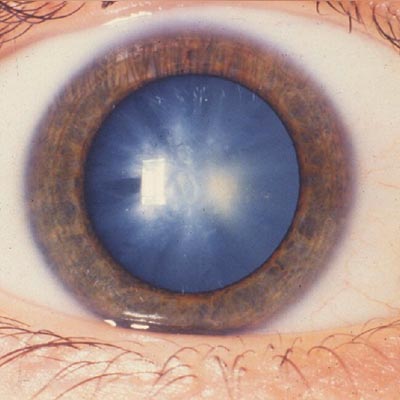 Catarata congénita. Enfermedades y tratamientos para los problemas oculares por el Instituto Oftalmológico Recoletas.