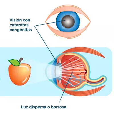 Agujero macular IOR Instituto oftalmológico