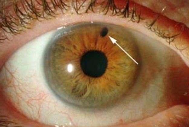 Iridotomia. Enfermedades y tratamientos para los problemas oculares por el Instituto Oftalmológico Recoletas.