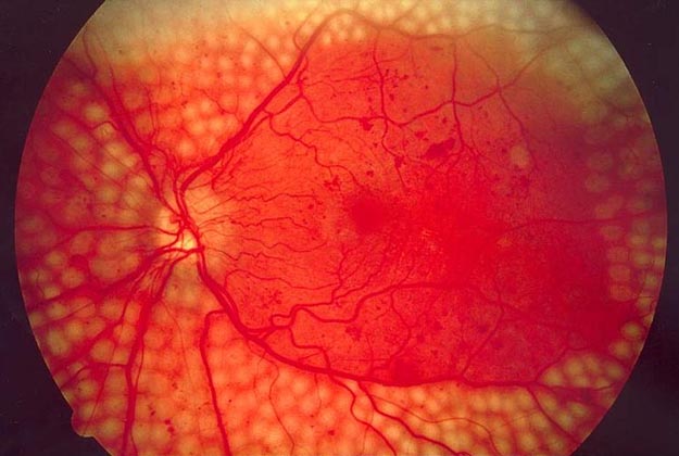 Retinopatía Diabética. Enfermedades y tratamientos para los problemas oculares por el Instituto Oftalmológico Recoletas.