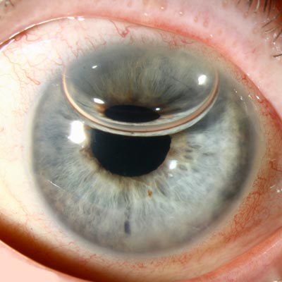 DMEK. Enfermedades y tratamientos para los problemas oculares por el Instituto Oftalmológico Recoletas.