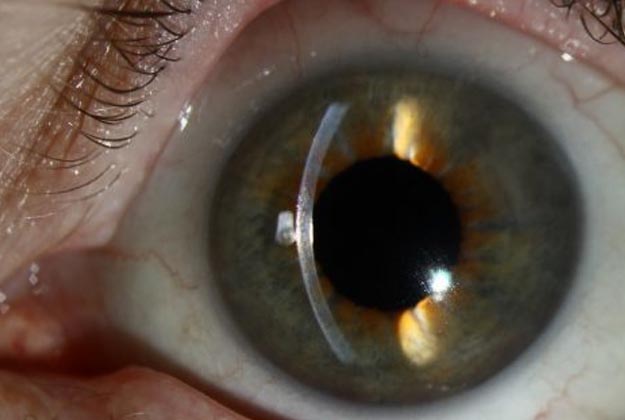 DMEK. Enfermedades y tratamientos para los problemas oculares por el Instituto Oftalmológico Recoletas.