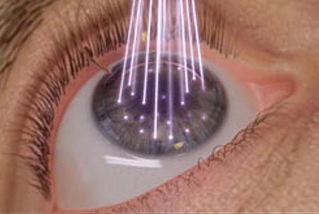 Láser Excimer. Enfermedades y tratamientos para los problemas oculares por el Instituto Oftalmológico Recoletas.