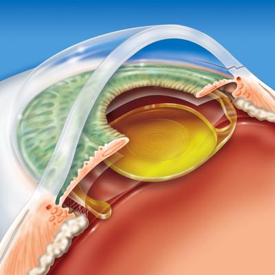 Gran roble cirujano erótico Cirugía refractiva con lentes pseudofáquicas - Instituto Oftalmológico  Recoletas