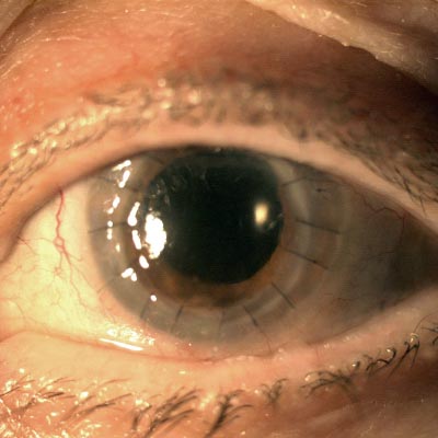 Transplante de córnea. Enfermedades y tratamientos para los problemas oculares por el Instituto Oftalmológico Recoletas.
