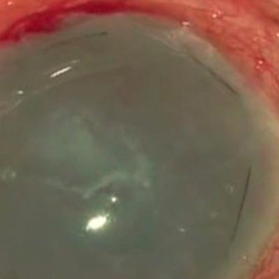 Transplante de membrana amníotica. Enfermedades y tratamientos para los problemas oculares por el Instituto Oftalmológico Recoletas.