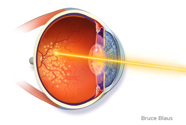 Fotocoagulación láser. Enfermedades y tratamientos oculares que se tratan en el Instituto Oftalmológico Recoletas.