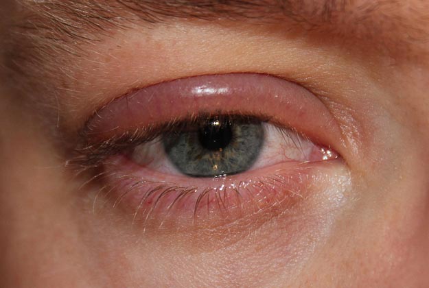 Blefaritis. Enfermedades y tratamientos oculares que se tratan en el Instituto Oftalmológico Recoletas