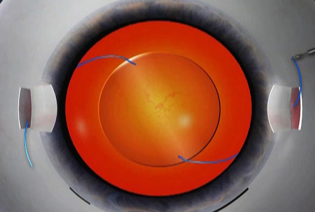 Cirugía clásica o cirugía escleral. Enfermedades y tratamientos oculares que se tratan en el Instituto Oftalmológico Recoletas.