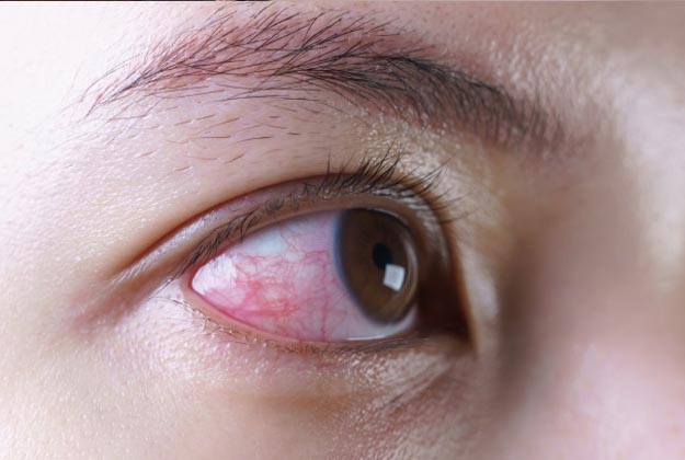 Uveítis anterior. Enfermedades y tratamientos oculares que se tratan en el Instituto Oftalmológico Recoletas.