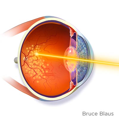 Fotocoagulación láser. Enfermedades y tratamientos oculares que se tratan en el Instituto Oftalmológico Recoletas.
