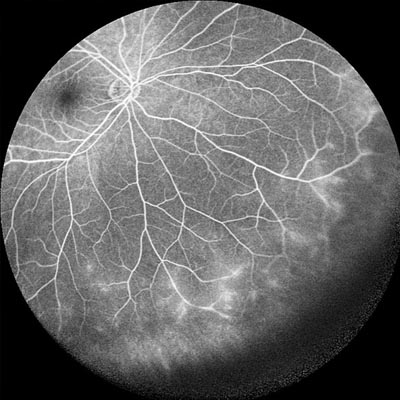 Uveítis. Enfermedades y tratamientos oculares que se tratan en el Instituto Oftalmológico Recoletas.