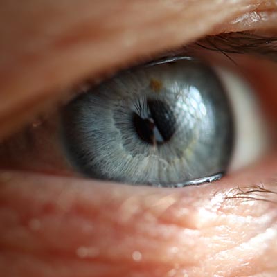 Uveítis Posterior. Enfermedades y tratamientos oculares que se tratan en el Instituto Oftalmológico Recoletas.