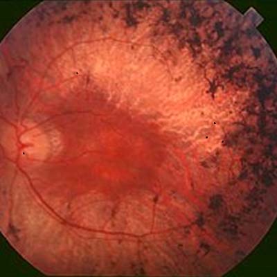 Retinosis pigmentaria. Enfermedades y tratamientos para los problemas oculares por el Instituto Oftalmológico Recoletas.