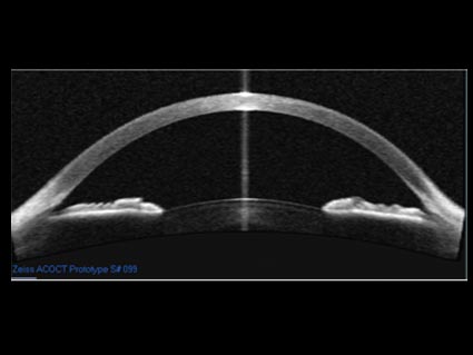 OCT o Tomografía de coherencia óptica. Instalaciones y equipación para los problemas oculares del Instituto Oftalmológico Recoletas.