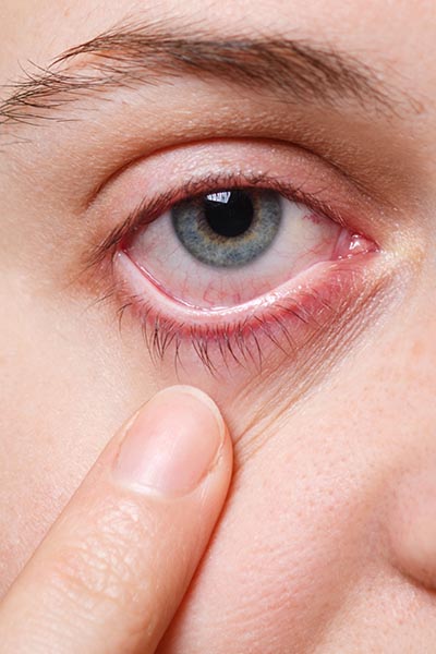 Blefaritis. Enfermedades y tratamientos oculares que se tratan en el Instituto Oftalmológico Recoletas
