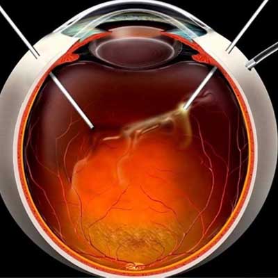Agujero macular. Enfermedades y tratamientos para los problemas oculares por el Instituto Oftalmológico Recoletas.