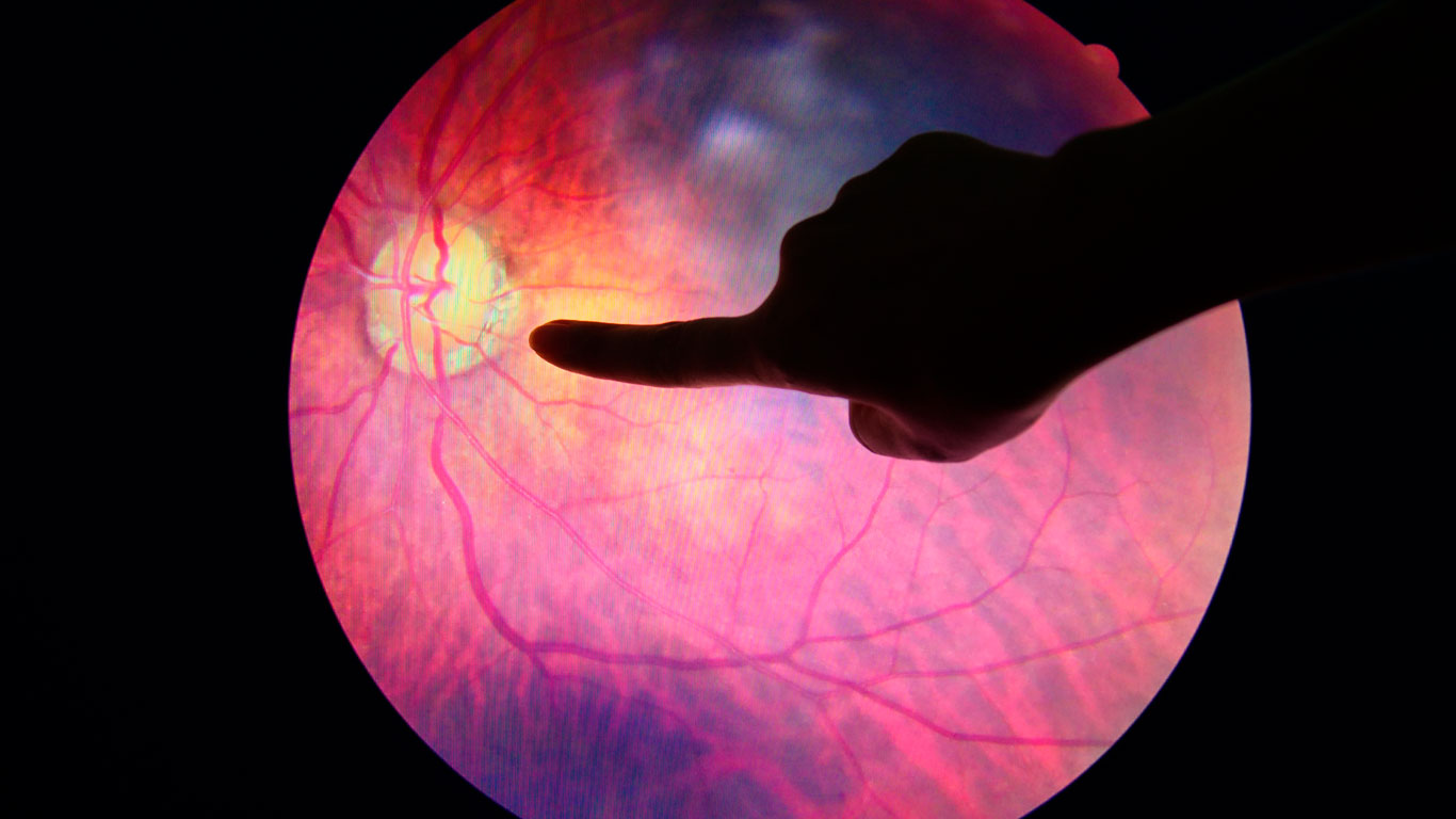 retinopatía-diabética-¿qué sabes