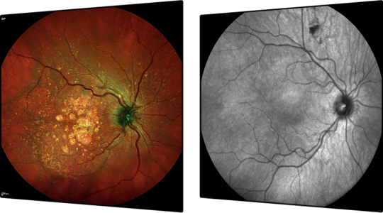 Láser Excimer. Enfermedades y tratamientos para los problemas oculares por el Instituto Oftalmológico Recoletas.